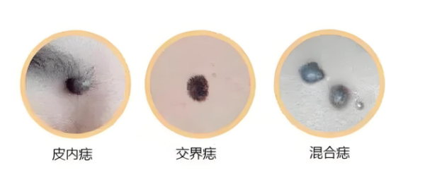 这几个方位长“痣”, 可能会癌变! 大夫关键提醒
